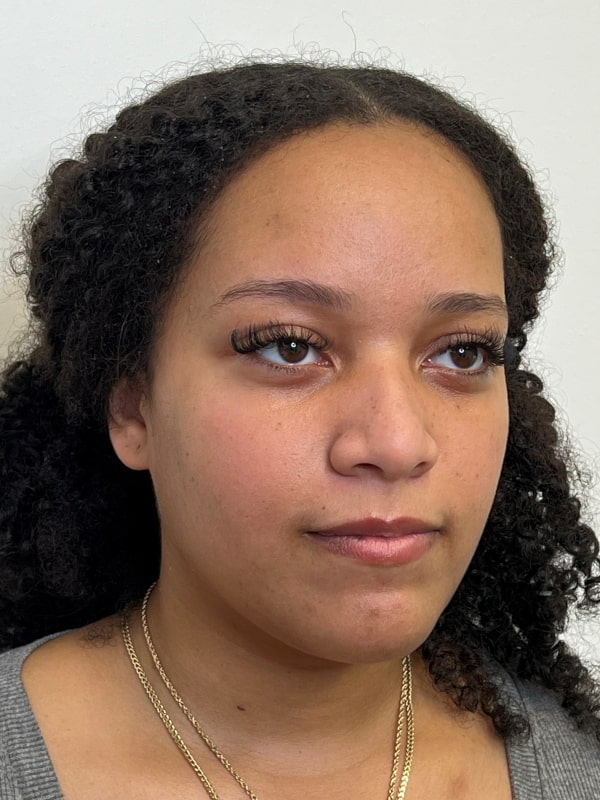 Under Eye Filler Before & After Image