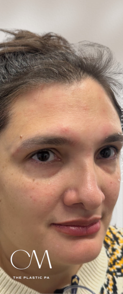 Under Eye Filler Before & After Image