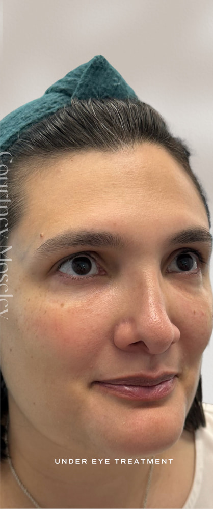 Under Eye Filler Before & After Image